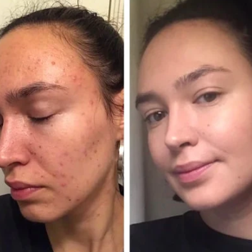 GlowMe™ - Ексфолиращи тампони с куркума, койева киселина и витамини